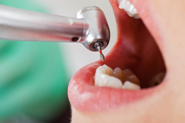 Best Same-Day Emergency Dentist in Elkhorn, CA